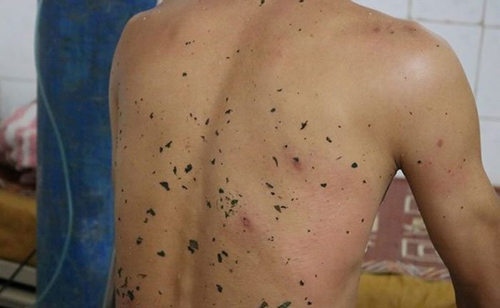 Ong vò vẽ tấn công, 11 người ở Nghệ An thương vong