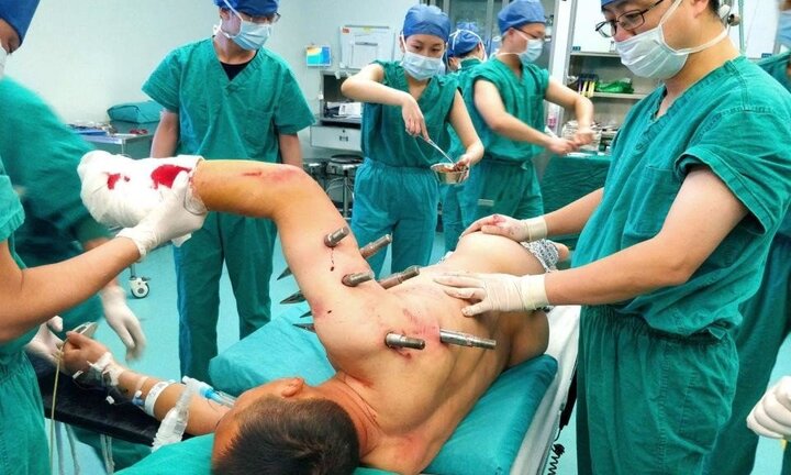 Bị 10 chiếc đinh dài xuyên vào người, bệnh nhân 49 tuổi sống sót thần kỳ