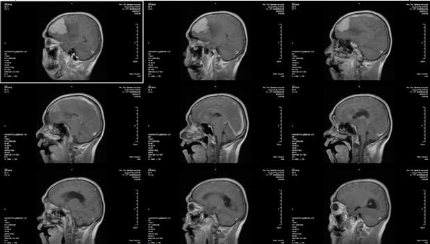 Phẫu thuật thành công u màng não khổng lồ cho người đàn ông 49 tuổi