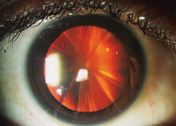 Người phụ nữ có đôi mắt như 'bánh pizza cắt lát'