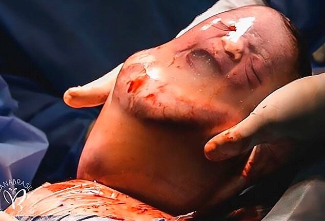 Em bé sinh ra trong túi ối còn nguyên vẹn dù sinh mổ