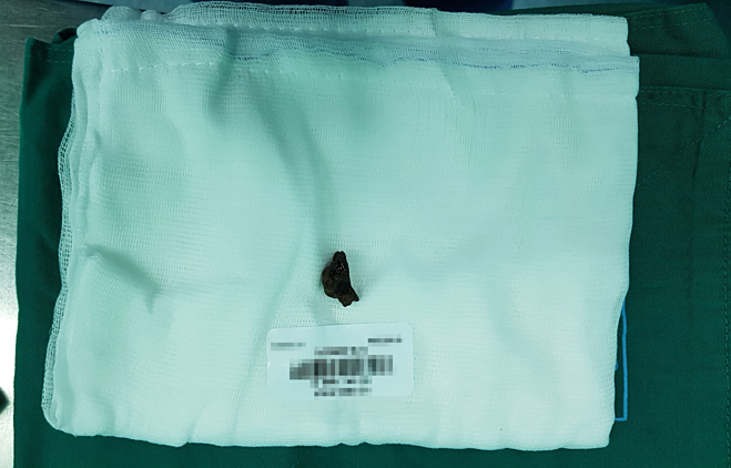 Gắp mảnh đạn găm trong lưng người đàn ông suốt 40 năm