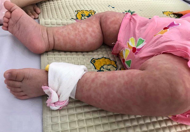 WHO: Bệnh sởi bùng phát ở quy mô mạnh nhất trong lịch sử nhân loại