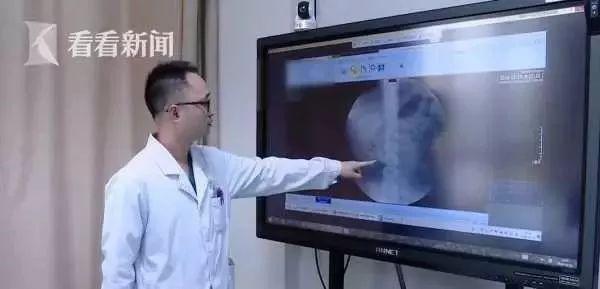 Bé 9 tuổi có 56 viên sỏi trong thận do thói quen ăn nhiều thịt