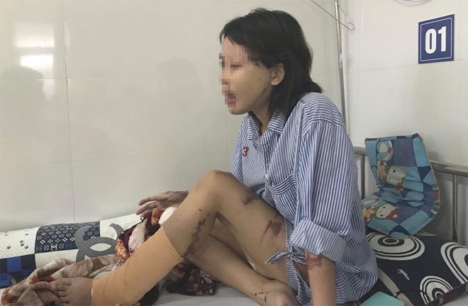 Cô gái xinh đẹp bị chồng sắp cưới tạt axit: 'Tôi trắng tay rồi'