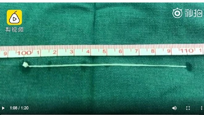 Sán làm tổ trong não, người đàn ông lên cơn co giật 20 lần mỗi ngày