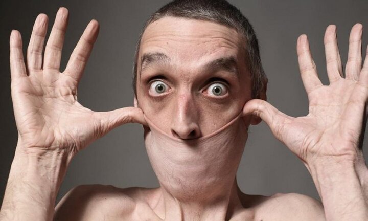 Sở hữu làn da đàn hồi nhất thế giới, 'dị nhân' có thể kéo da ở cổ lên như chiếc khẩu trang