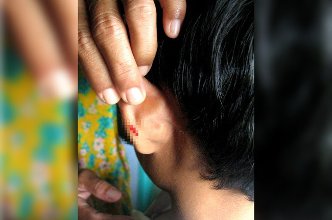 Không làm bài tập về nhà, học sinh lớp 4 bị giáo viên phạt dập ghim vào tai