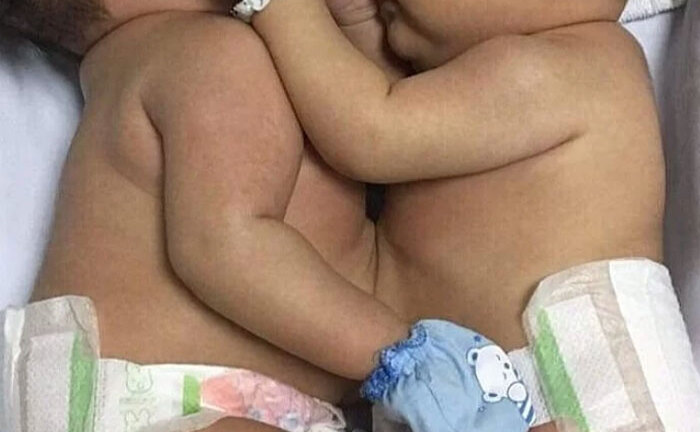 Phẫu thuật tách hai bé gái song sinh dính nhau ở gan