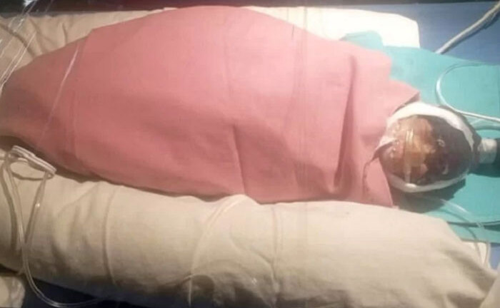 Cụ bà 75 tuổi ở Ấn Độ sinh con nặng 600g