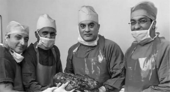 Phẫu thuật cắt bỏ quả thận khồng lồ 7,4 kg khỏi bệnh nhân