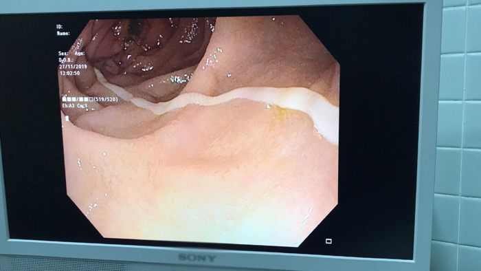 Con sán dây hơn một mét trong ruột bệnh nhân có thói quen ăn bò tái