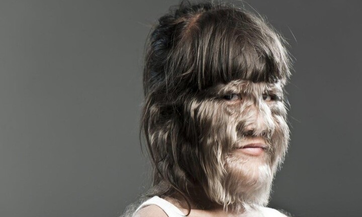 10 căn bệnh kỳ lạ, hiếm gặp nhất trên thế giới