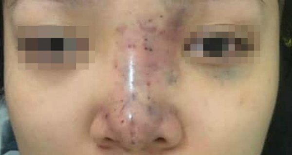 Chủ spa biến mất sau ca nâng mũi khiến nữ sinh TP.HCM mù mắt