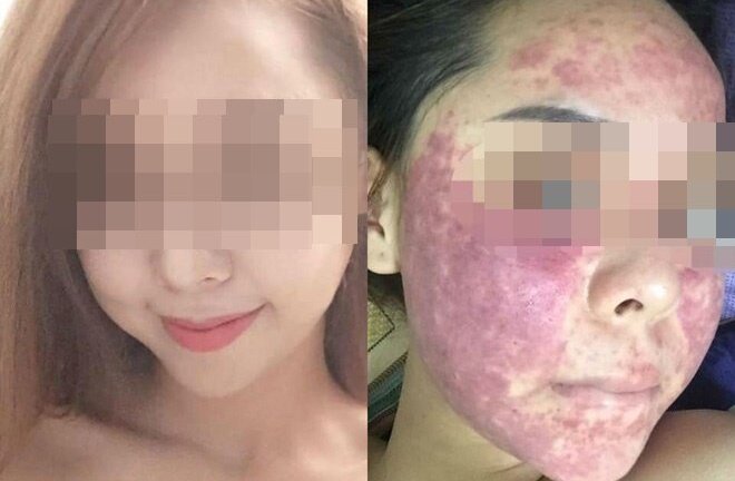 Bị mỹ phẩm phá nát mặt, cô gái phải dừng hôn lễ