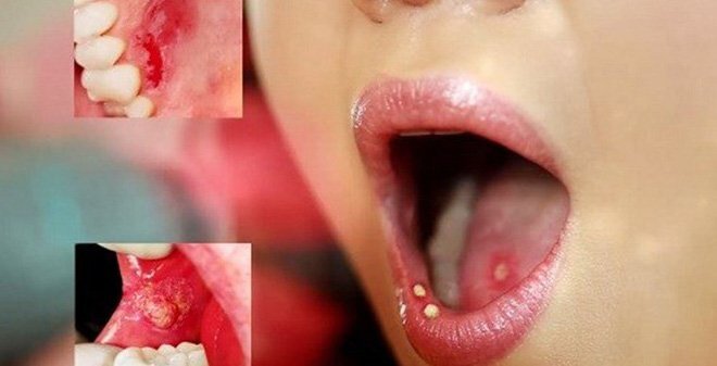 Cảnh báo: Vết lở loét nhỏ trong miệng có thể là dấu hiệu của bệnh ung thư 'chết người'