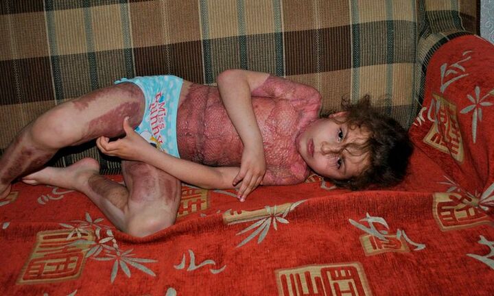 Bé gái 5 tuổi bị đốt cháy kinh hoàng vì mơ trở thành 'nàng tiên lửa' giống trên mạng