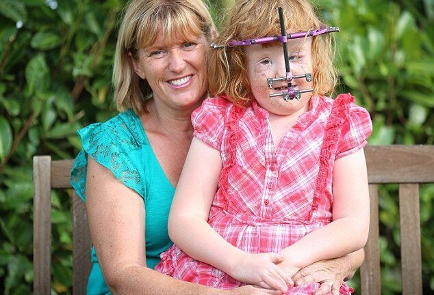 Mắc hội chứng Apert như bé Bôm, bé gái may mắn được tái sinh với khuôn mặt mới