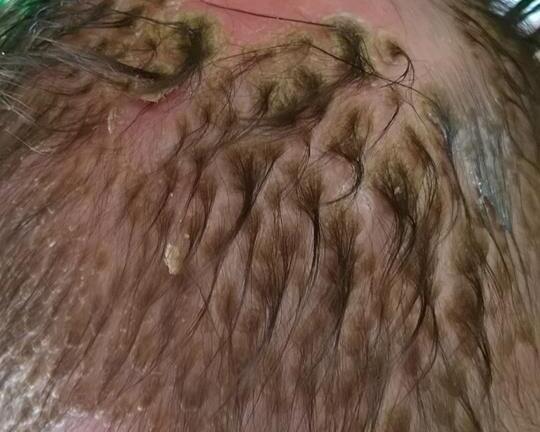 Xót xa mẹ gãi 'cứt trâu' cho con đến bong tróc cả mảng tóc, rộp đỏ da đầu