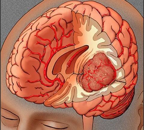 Nếu biết sớm điều này, u não sẽ không hoàn toàn là căn bệnh tử thần