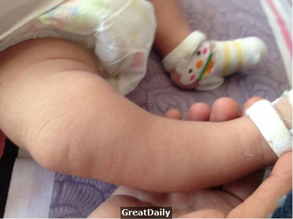 Mẹ mua giày lớn hơn 1 size để con đi được lâu, nào ngờ suýt hại con gãy xương chân