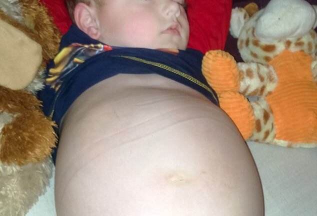 Chủ quan tưởng bụng to do tăng cân, bà mẹ không ngờ con mắc trọng bệnh