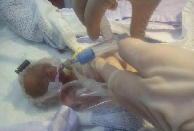 Sức sống kỳ diệu của em bé sinh non khi mới 25 tuần, cơ thể chỉ to bằng quả bóng tennis