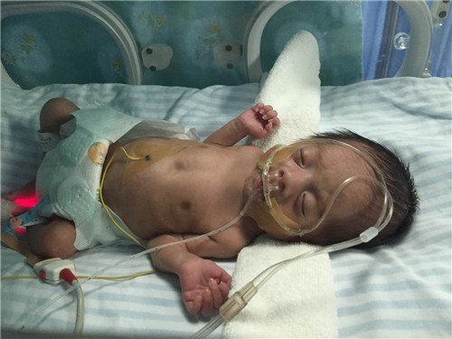 Bé sơ sinh 13 ngày tuổi bị hoại tử ruột vì mẹ pha sữa sai cách