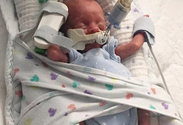 Kỳ diệu em bé sống sót khi sinh non ở tuần 22, làn da trong suốt nhìn thấy cả nội tạng