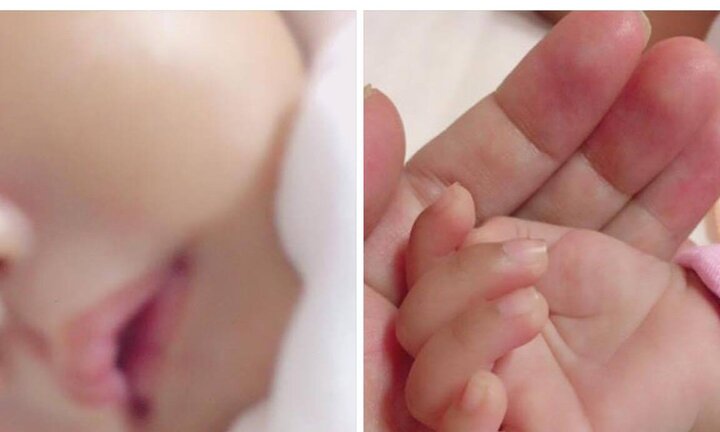 Bé sơ sinh xuất huyết não do thiếu vitamin K và lời cảnh tỉnh tới các mẹ