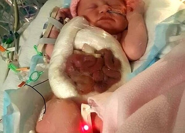 Bé gái sống sót kỳ diệu dù nứt bụng bẩm sinh, ruột nằm... ngoài bụng
