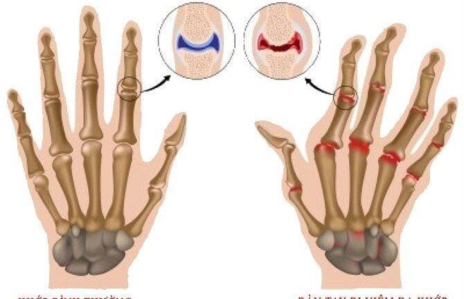Đánh máy liên tục 8 tiếng một ngày, biên tập viên bị hủy khớp tay