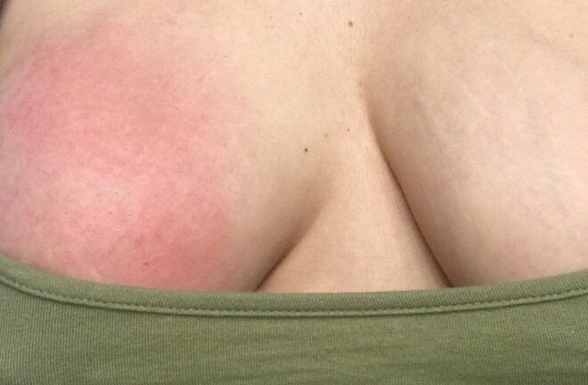 Xót xa nhìn bầu ngực sưng tím chứa đầy dịch của người mẹ khi cho con bú