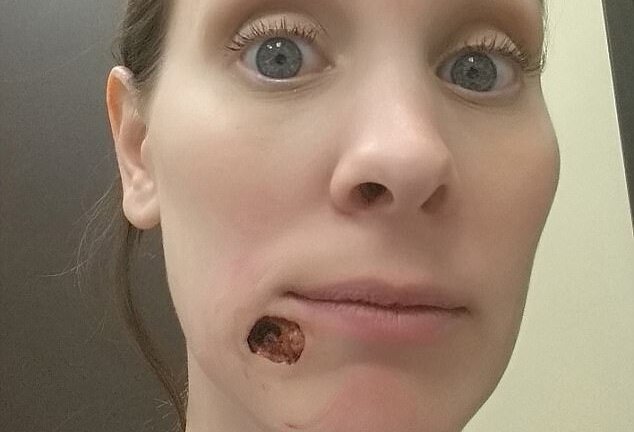 Kinh hoàng mụn khổng lồ trên mặt bà mẹ 35 tuổi báo hiệu bệnh nguy hiểm