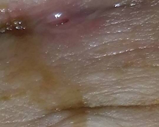 Mẹ bỉm sữa chảy mủ, sưng tấy vết mổ vì dị ứng chỉ tự tiêu sau sinh