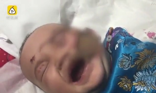 Ngã vào bếp lò dùng để sưởi ấm, bé gái bỏng cấp độ 3