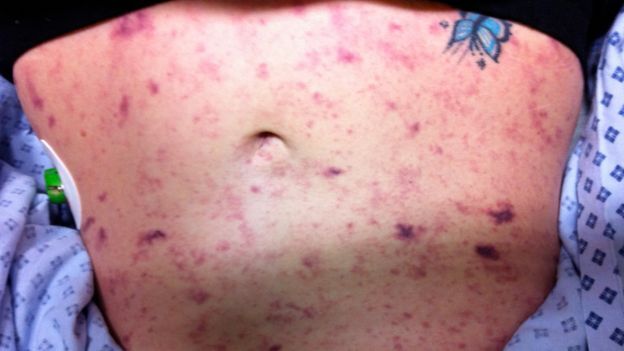 Xét nghiệm viêm màng não mới có thể cứu sống người bệnh