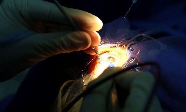 Hàng triệu người cần mổ mắt sợ đau nên đọc thông tin này