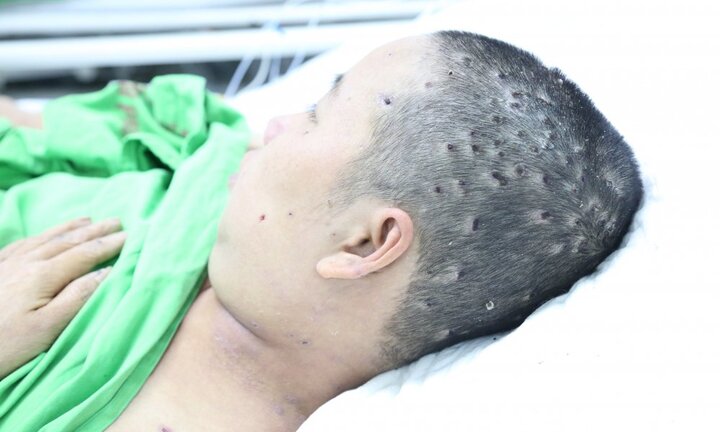 Bị ong đốt hơn 300 nốt, một phụ nữ được cứu sống kỳ diệu