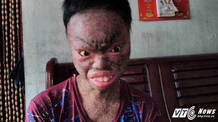 Nghẹn ngào tấm lòng của người mẹ có con trai là 'người vảy cá'