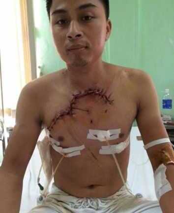 Xuyên đêm cứu sống bệnh nhân bị tai nạn giao thông, tim phổi lộ ra ngoài