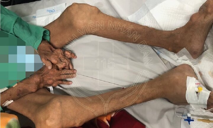 Uống thuốc giảm đau 10 năm liền, người đàn ông bị suy thận nặng, tay chân biến dạng