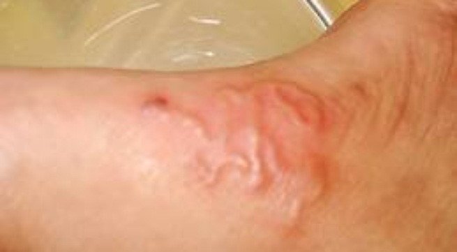 Cụ ông 63 tuổi nhiễm trùng, đau bụng liên tục vì mắc bệnh giun lươn