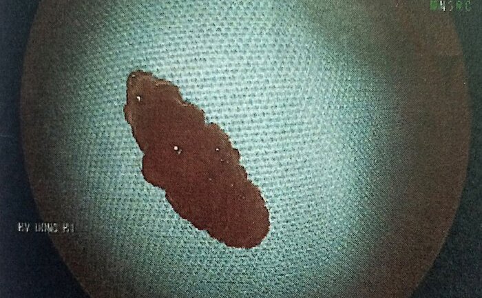 Nội soi dạ dày bệnh nhân, bác sĩ phát hiện 'bắt sống' một con sán lá gan lớn