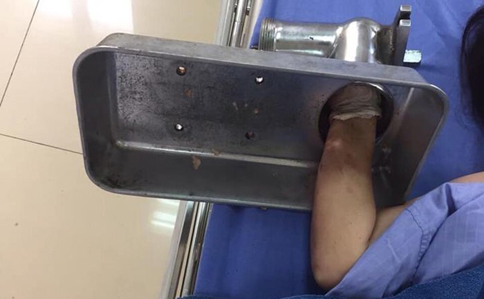 Cấp cứu một phụ nữ bị máy xay thịt cuốn nát bàn tay ở Quảng Ninh