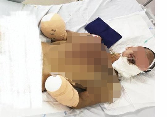 Người đàn ông bị cụt 2 tay sau vụ nổ lớn nghi do sản xuất pháo