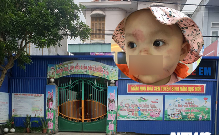 Công an làm rõ vụ bé 14 tháng tuổi bị nhiều vết bầm tím trên mặt ngày đầu đi học