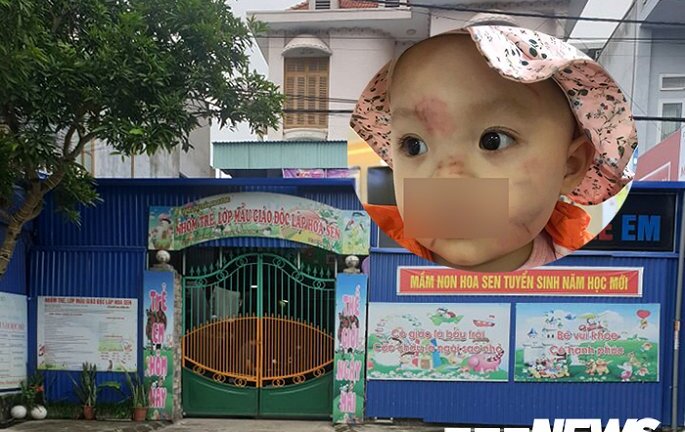 Bé 14 tháng tuổi ở Hải Phòng bị bạn cắn thâm tím mặt: Kiểm điểm làm rõ trách nhiệm 2 giáo viên