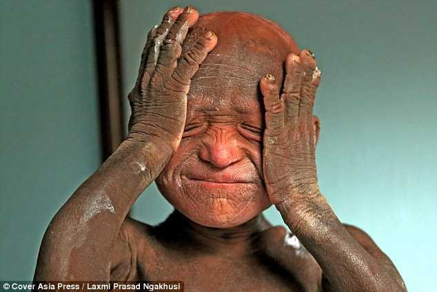 Cậu bé 'hóa đá' vì mắc bệnh da liễu hiếm gặp