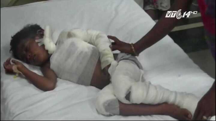 Bị bố đánh rơi vào đống than, bé 6 tuổi nguy kịch